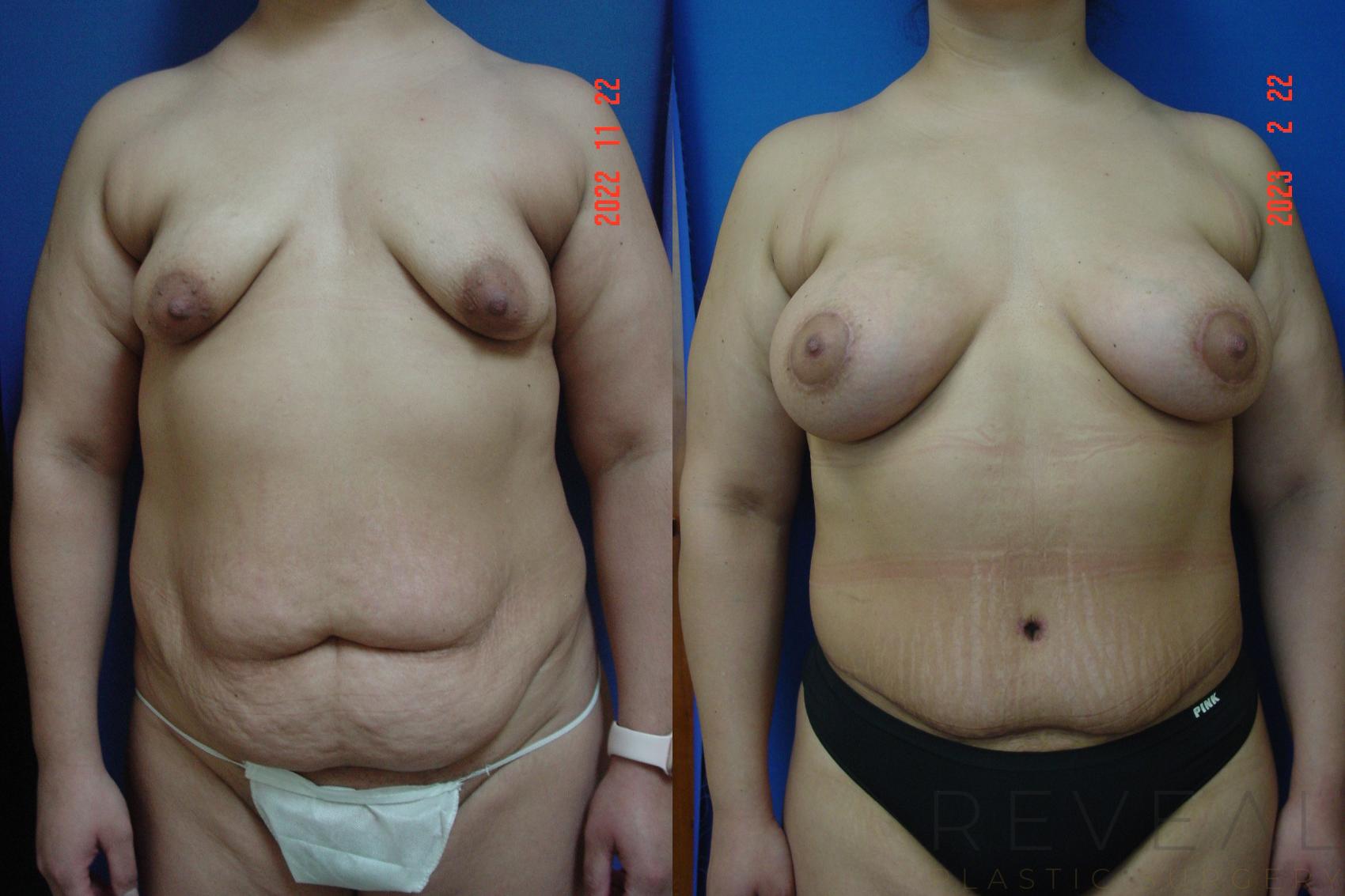 Before & After Breast Augmentation Case 722 Front View in San Jose, CA