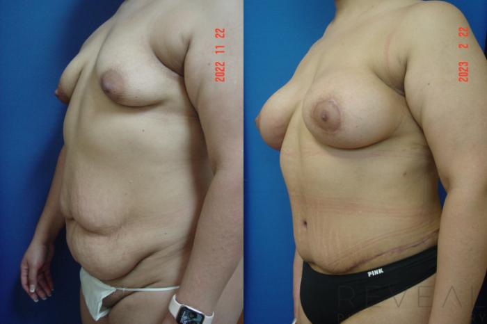 Before & After Tummy Tuck Case 722 Left Side View in San Jose, CA