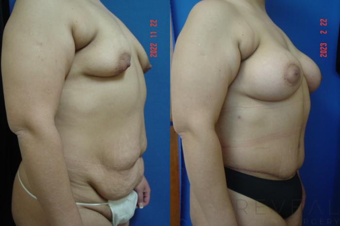 Before & After Tummy Tuck Case 722 Right Side View in San Jose, CA