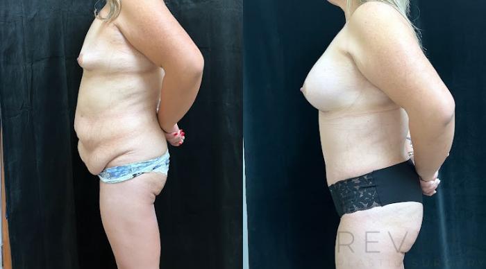 Before & After Tummy Tuck Case 738 Left Side View in San Jose, CA