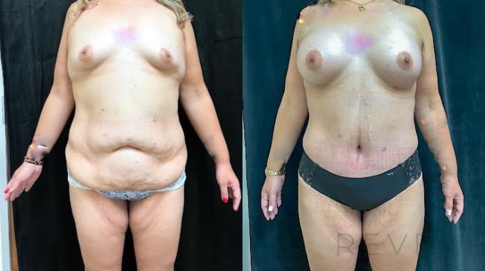 Before & After Tummy Tuck Case 743 Left Oblique View in San Jose, CA
