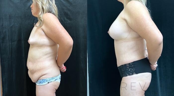 Before & After Tummy Tuck Case 743 Left Side View in San Jose, CA