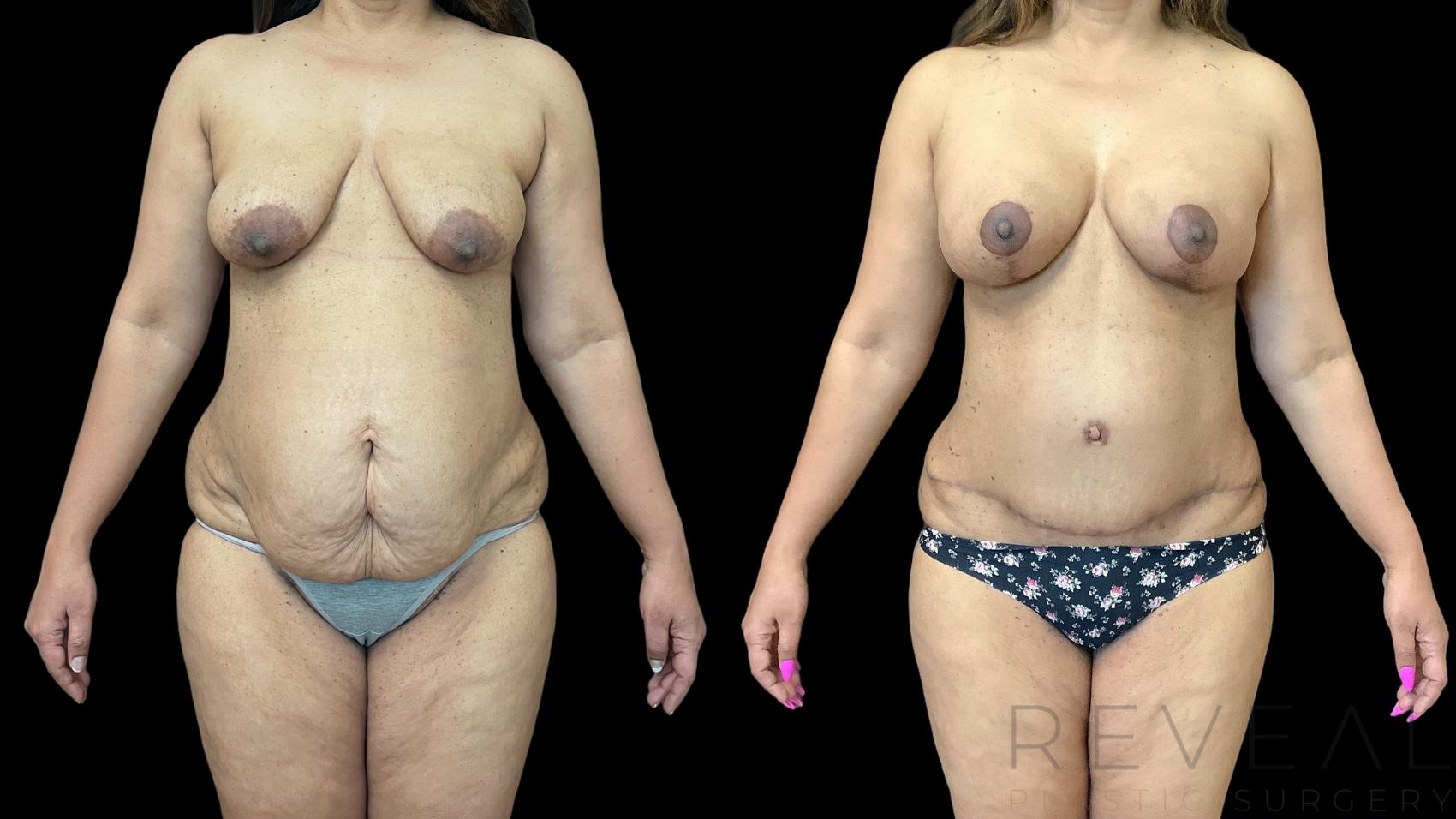Before & After Breast Augmentation Case 773 Front View in San Jose, CA