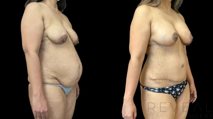 Before & After Mommy Makeover Case 773 Right Oblique View in San Jose, CA