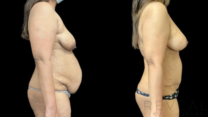 Before & After Tummy Tuck Case 773 Right Side View in San Jose, CA