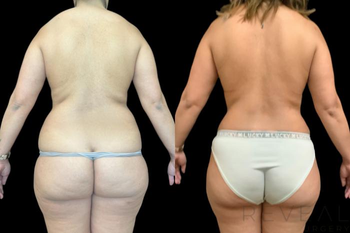 Before & After Breast Lift Case 776 Back View in San Jose, CA