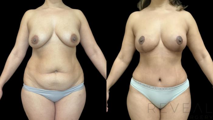 Before & After Breast Lift Case 776 Front View in San Jose, CA