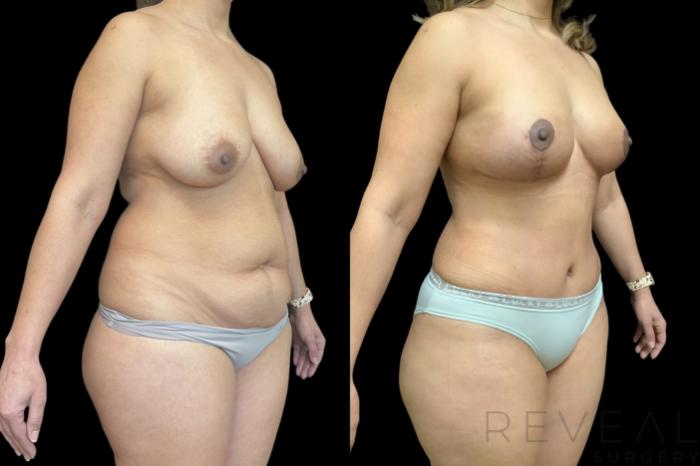 Before & After Mommy Makeover Case 776 Right Oblique View in San Jose, CA