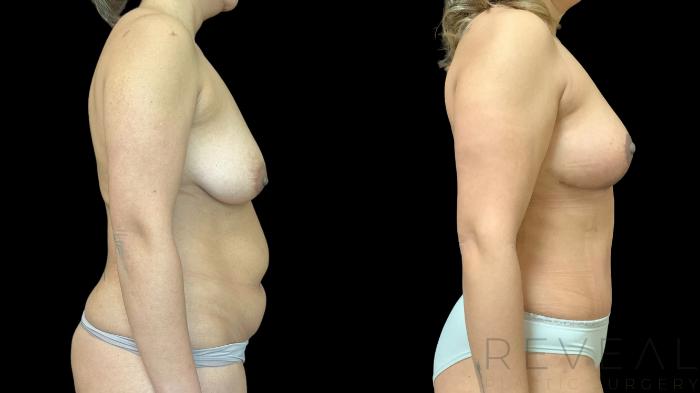 Before & After Breast Lift Case 776 Right Side View in San Jose, CA