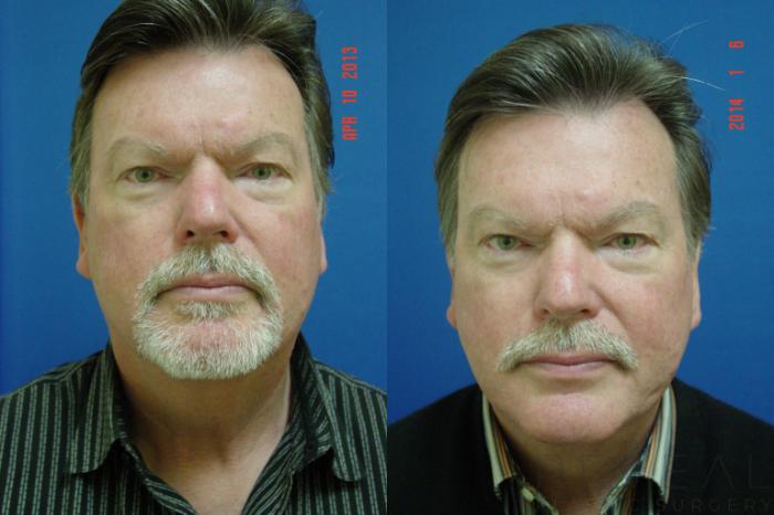 Before & After Neck Lift Case 123 View #2 View in San Jose, CA