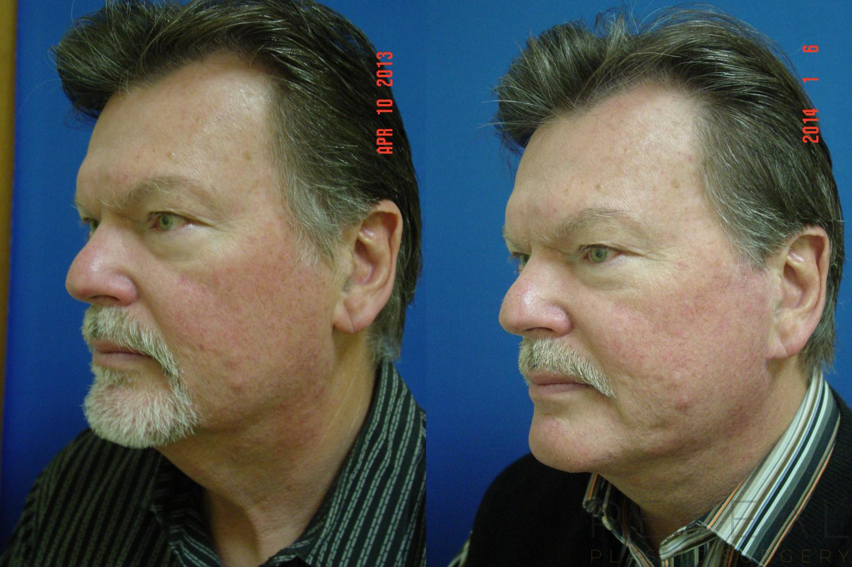 Before & After Neck Lift Case 123 View #3 View in San Jose, CA