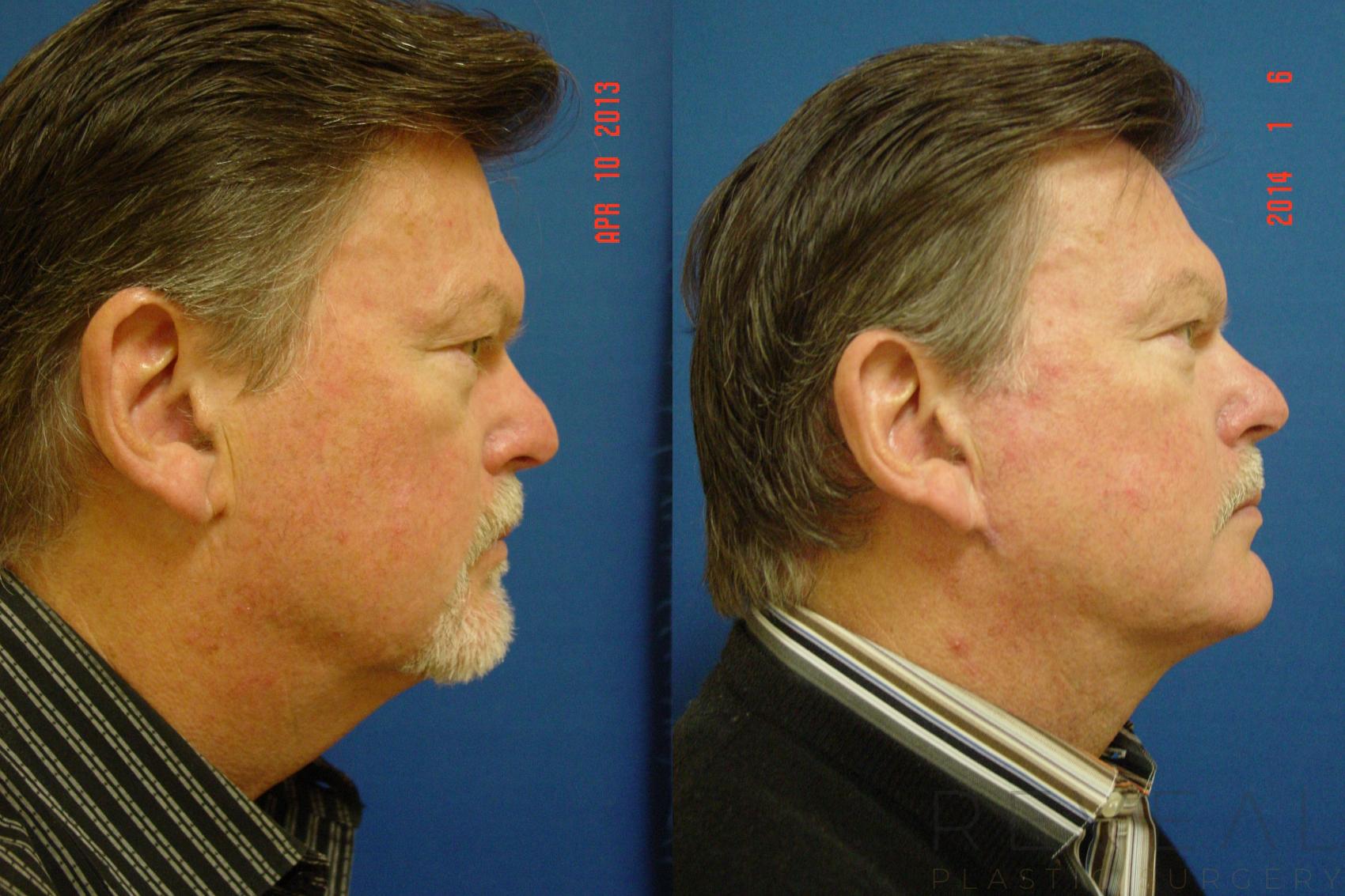 Before & After Neck Lift Case 123 View #4 View in San Jose, CA