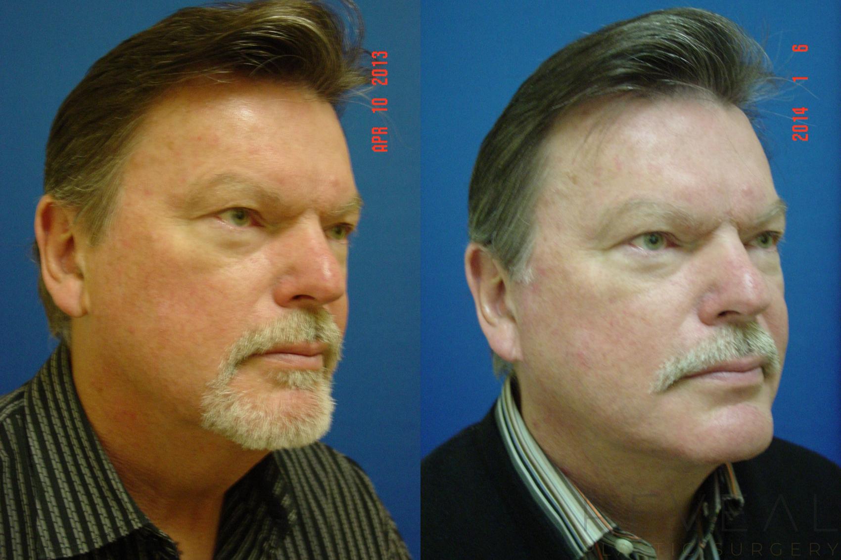 Before & After Neck Lift Case 123 View #5 View in San Jose, CA