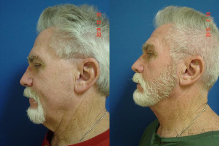 Before & After Neck Lift Case 171 View #1 View in San Jose, CA