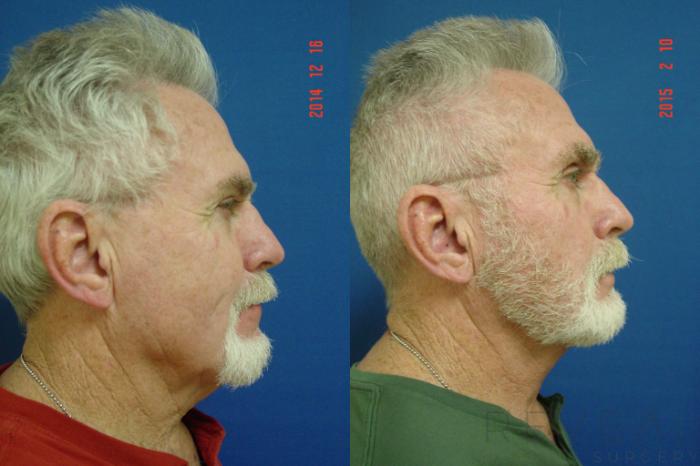 Before & After Neck Lift Case 171 View #3 View in San Jose, CA