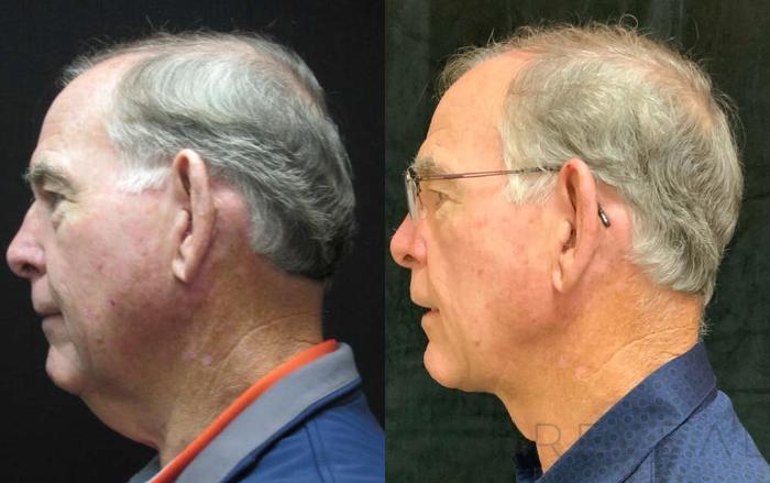 Before & After Neck Lift Case 458 View #1 View in San Jose, CA