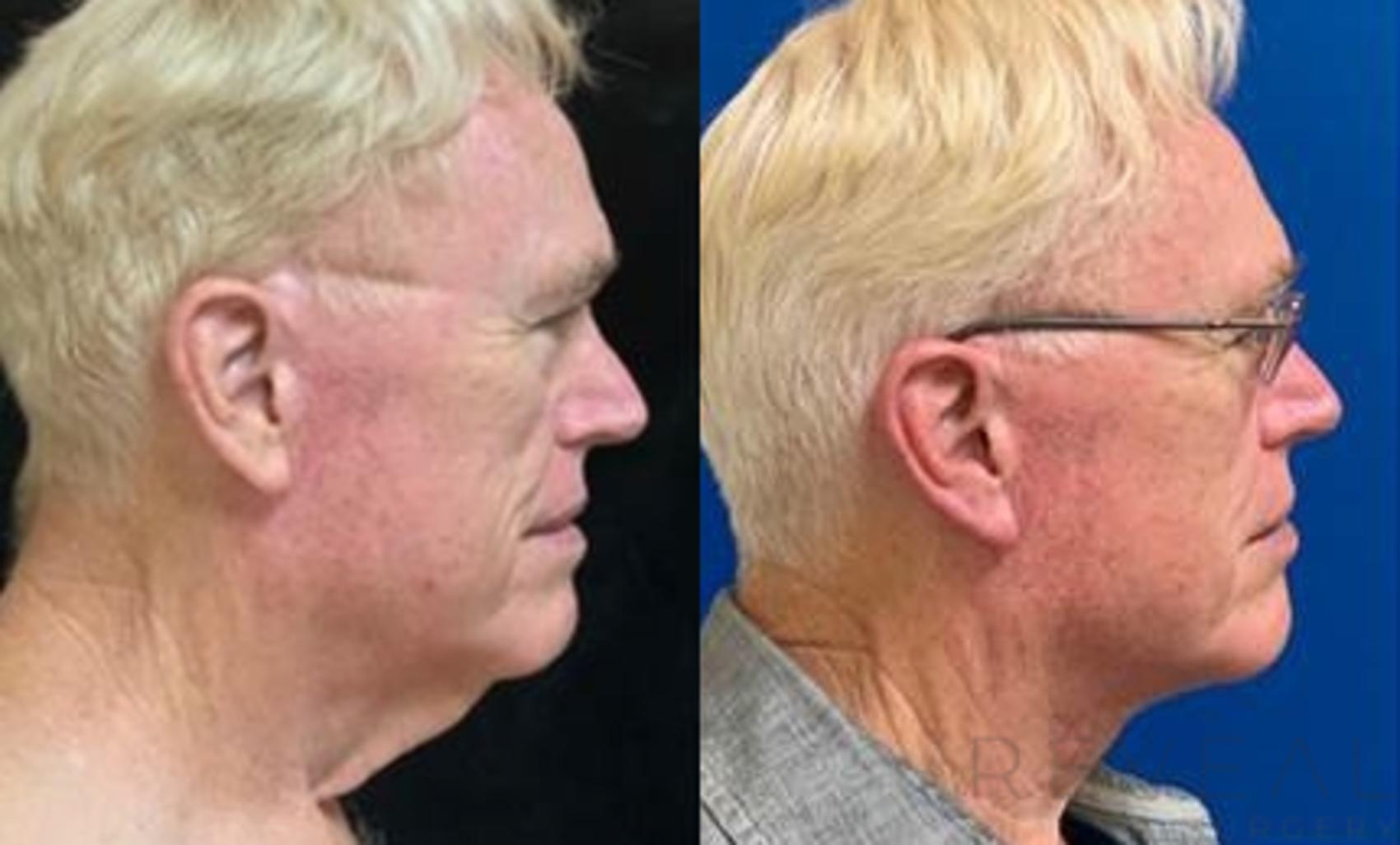 Before & After Neck Lift Case 464 View #1 View in San Jose, CA