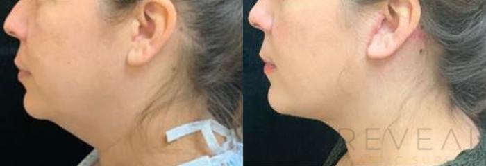 Before & After Liposuction Case 475 View #2 View in San Jose, CA
