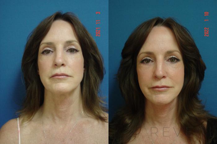 Before & After Neck Lift Case 603 Front View in San Jose, CA