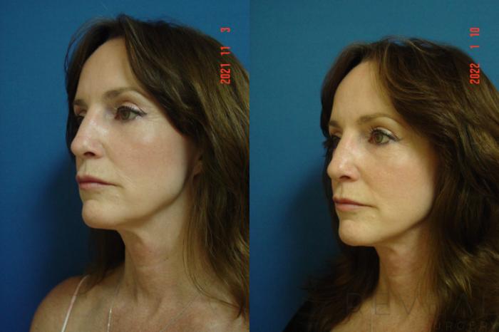 Before & After Neck Lift Case 603 Left Oblique View in San Jose, CA