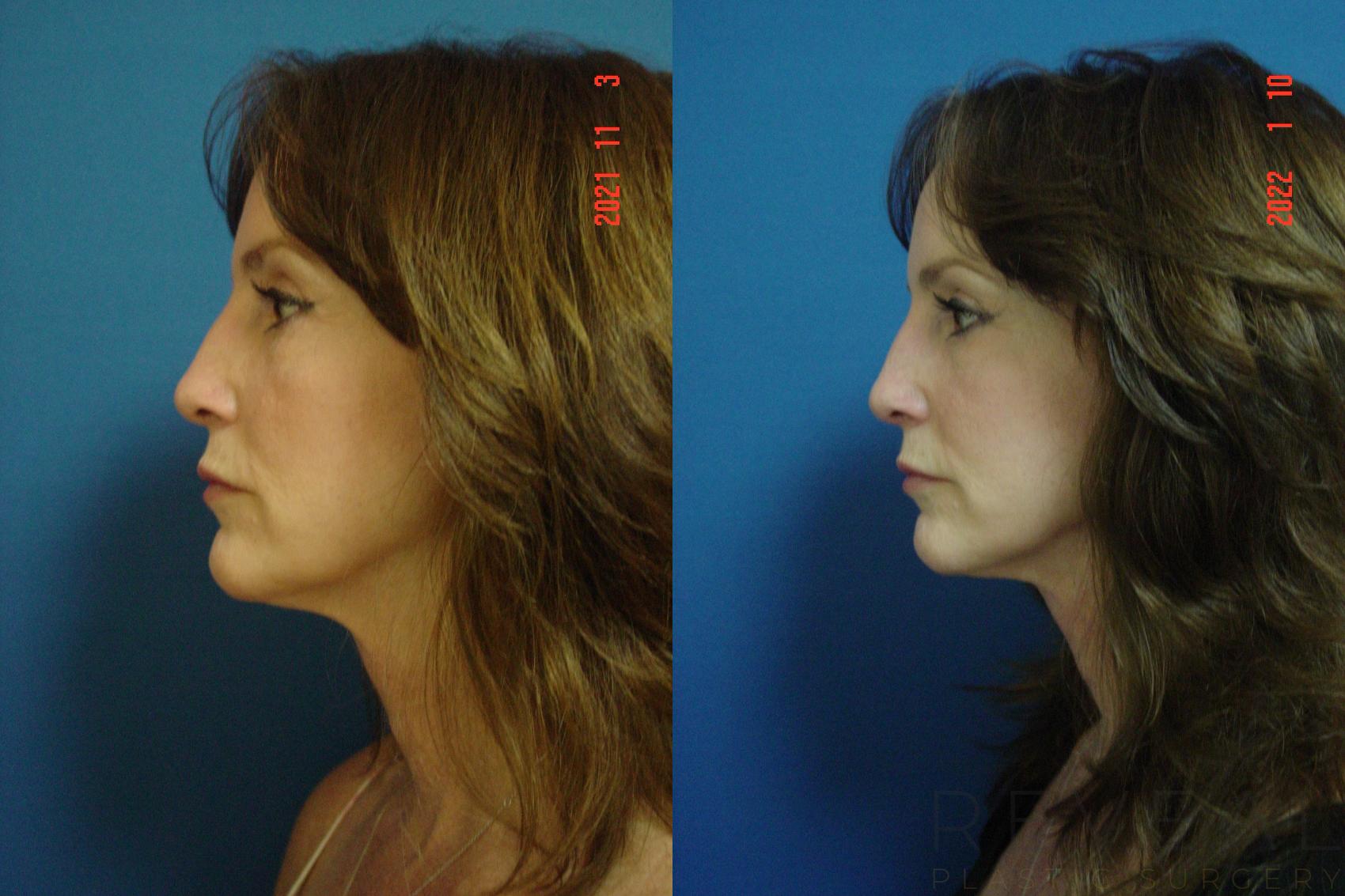 Before & After Neck Lift Case 603 Left Side View in San Jose, CA