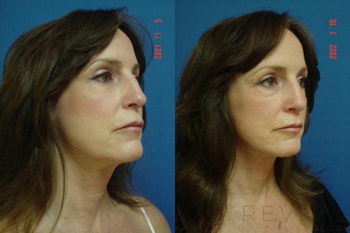 Before & After Neck Lift Case 603 Right Oblique View in San Jose, CA