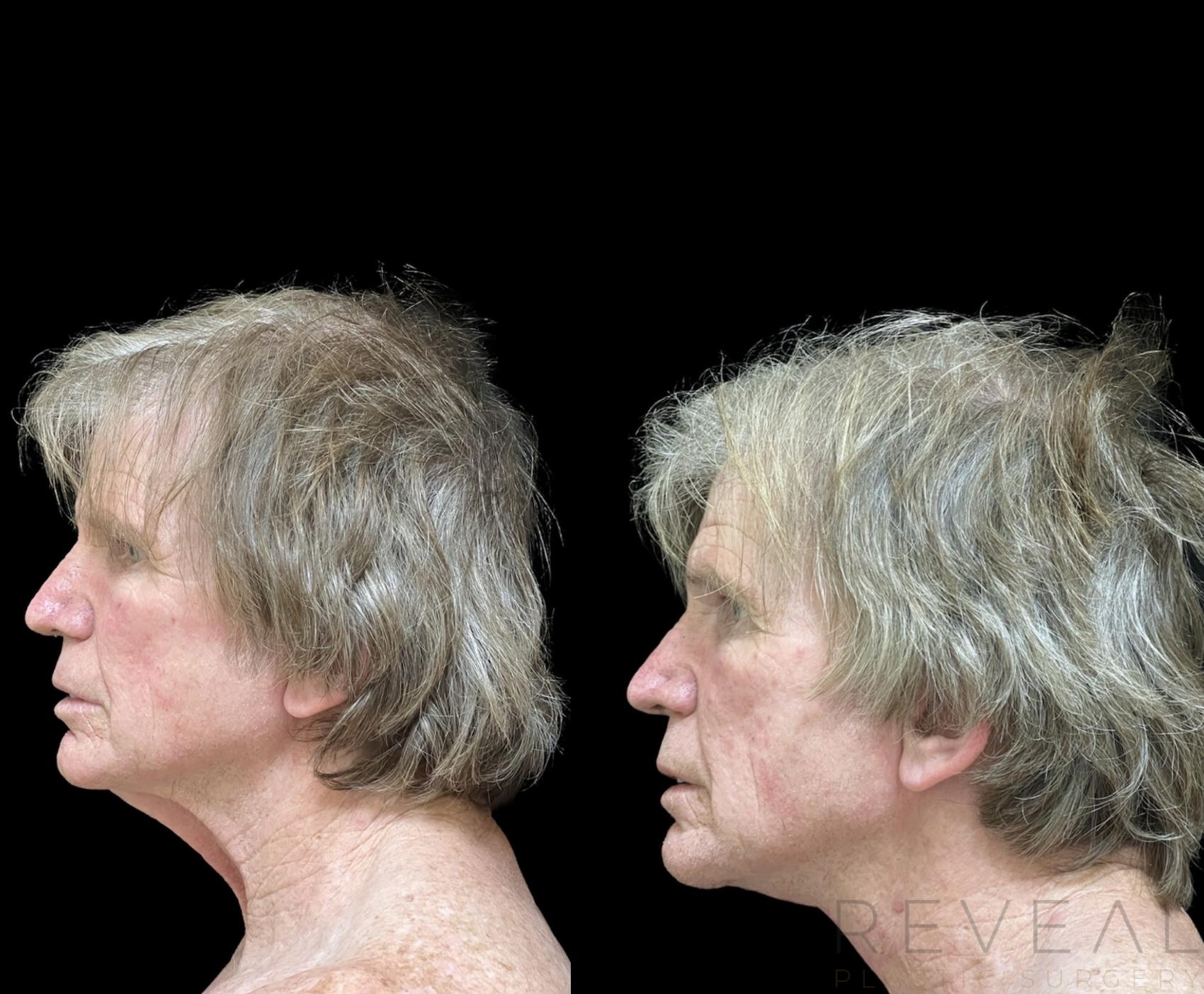 Before & After Neck Lift Case 650 Right Side View in San Jose, CA