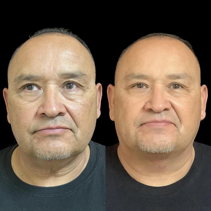 Before & After Neck Lift Case 710 Front View in San Jose, CA