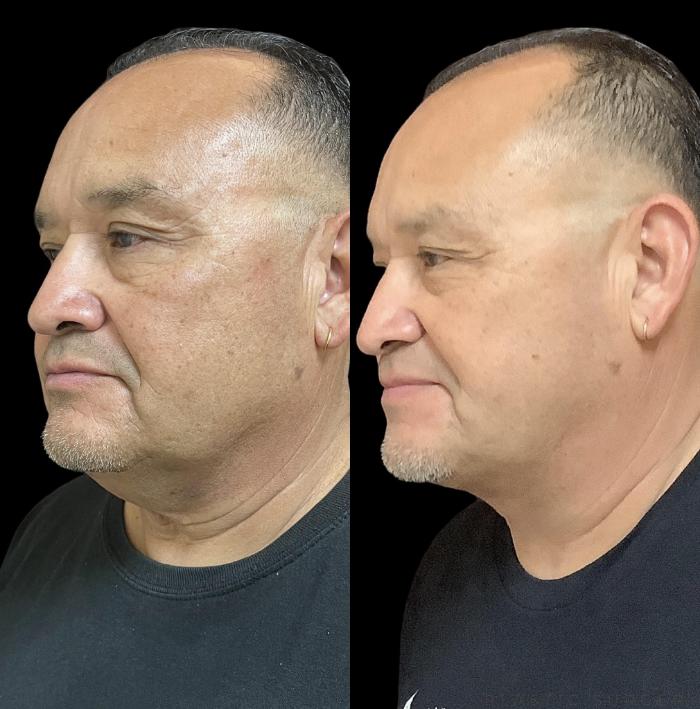 Before & After Neck Lift Case 710 Right Oblique View in San Jose, CA