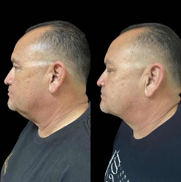Before & After Neck Lift Case 710 Right Side View in San Jose, CA