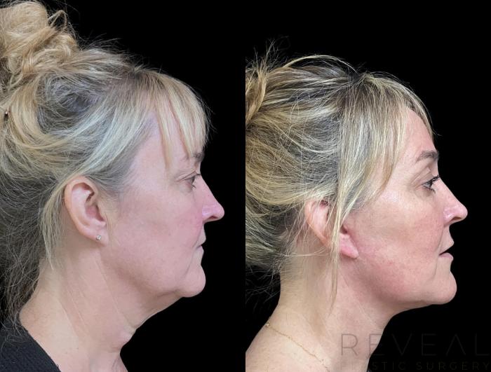 Before & After Neck Lift Case 735 Left Side View in San Jose, CA