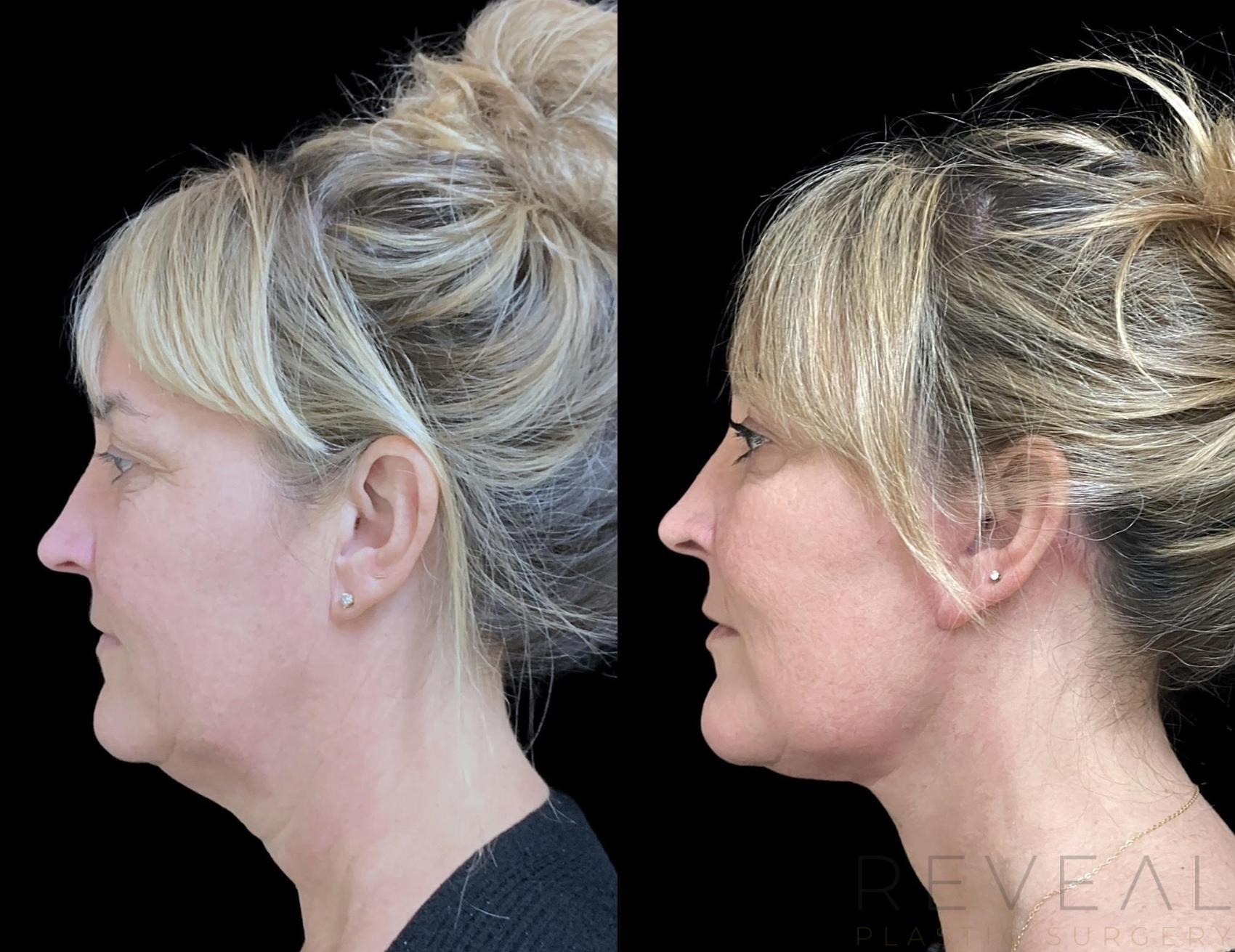 Before & After Neck Lift Case 735 Right Side View in San Jose, CA