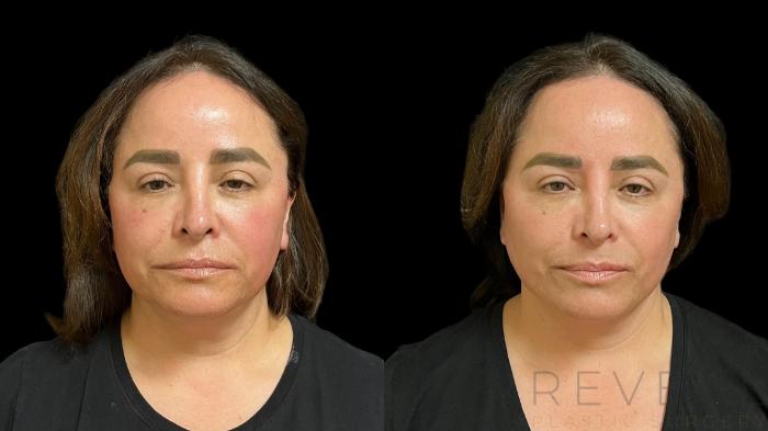 Before & After Neck Lift Case 775 Front View in San Jose, CA