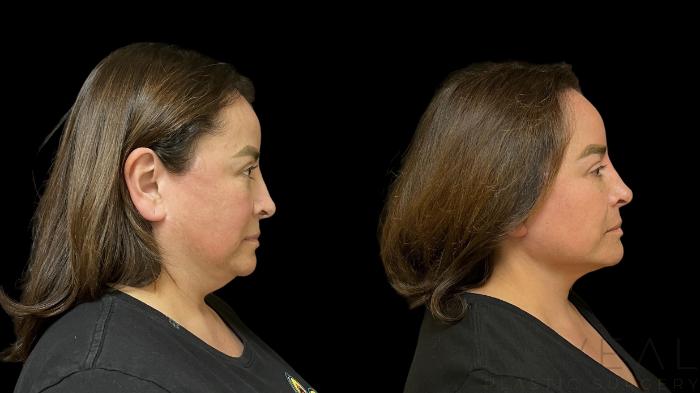 Before & After Neck Lift Case 775 Right Oblique View in San Jose, CA