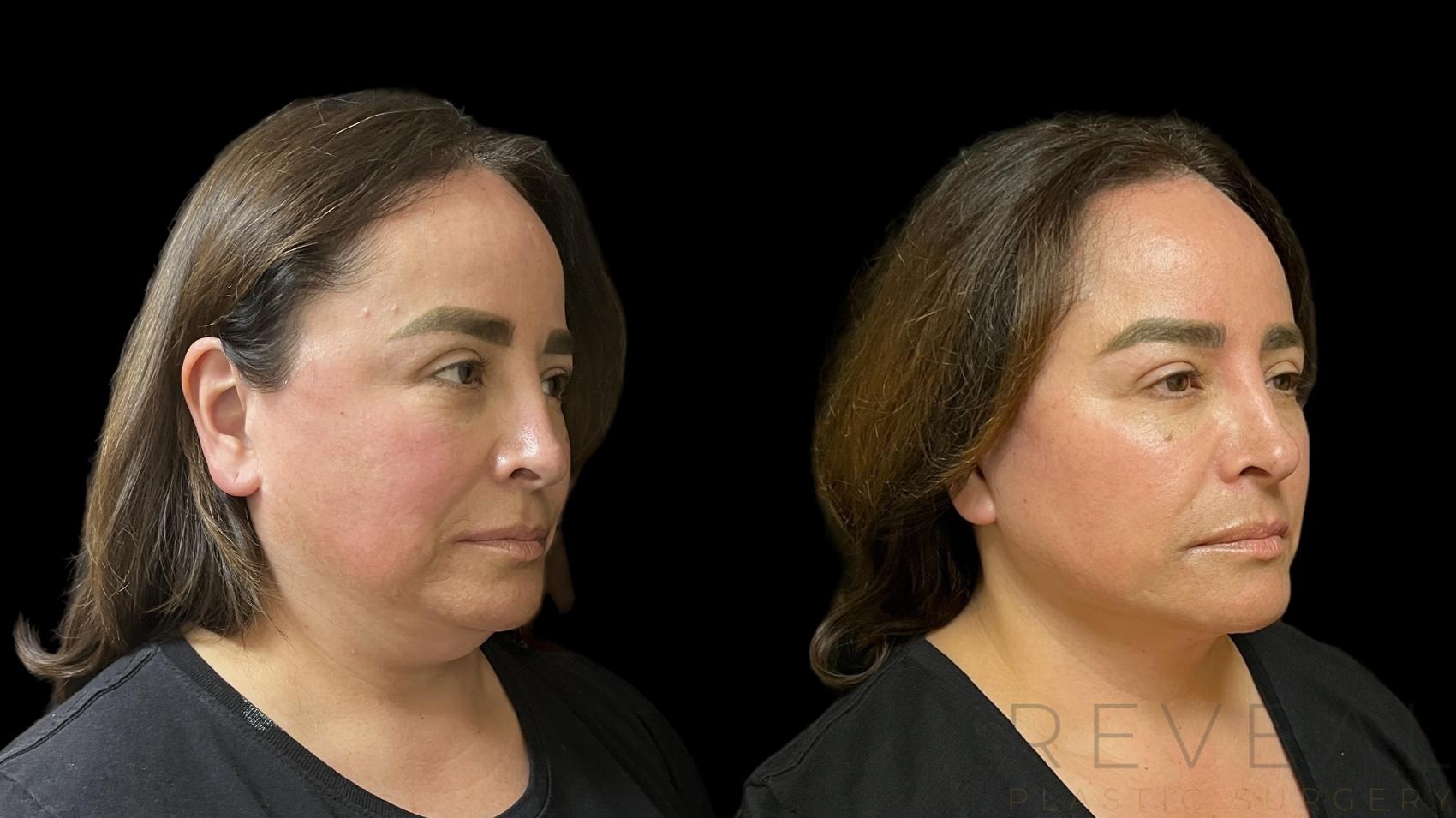Before & After Neck Lift Case 775 Right Side View in San Jose, CA