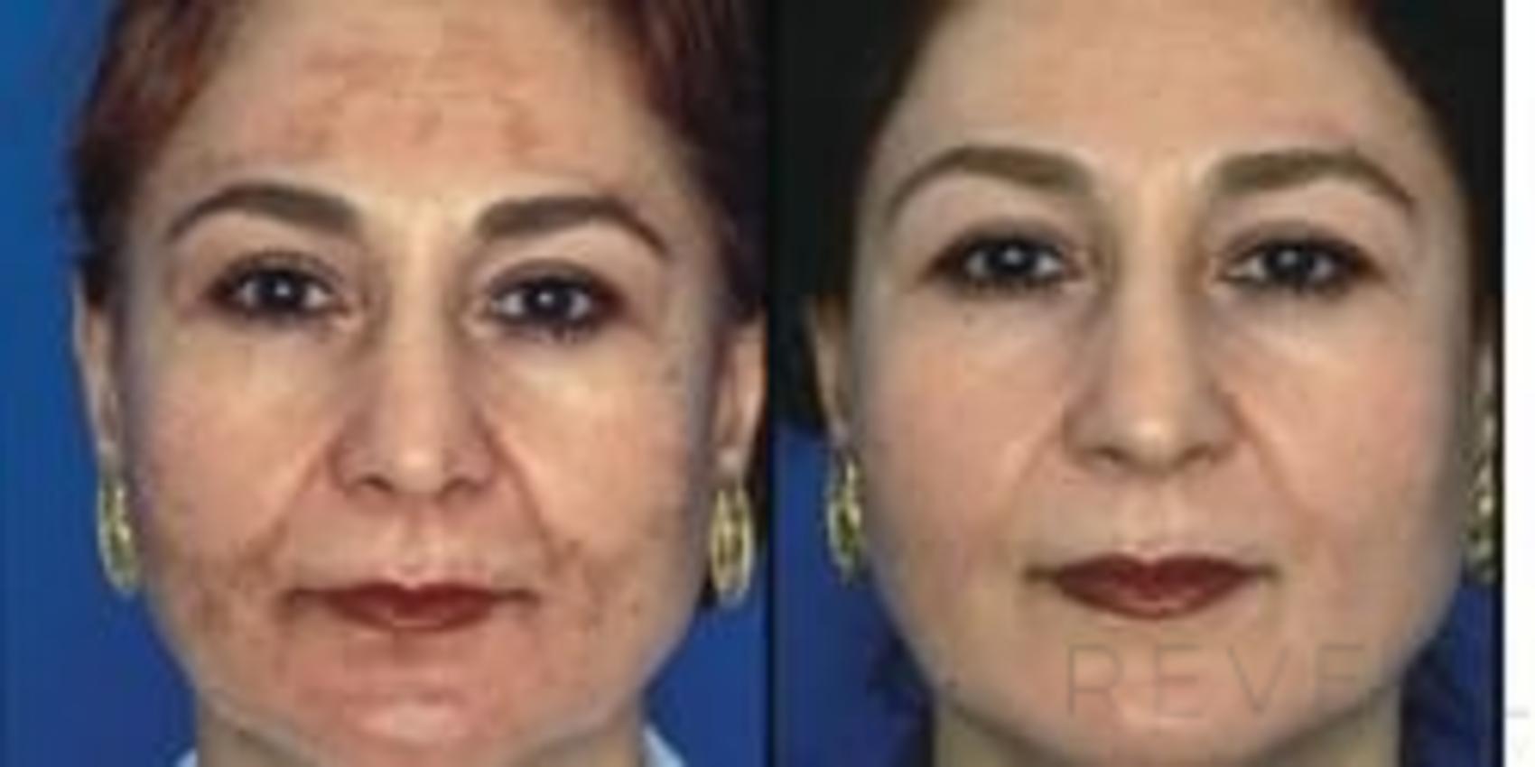 Before & After Peels & Resurfacing Case 23 View #1 View in San Jose, CA