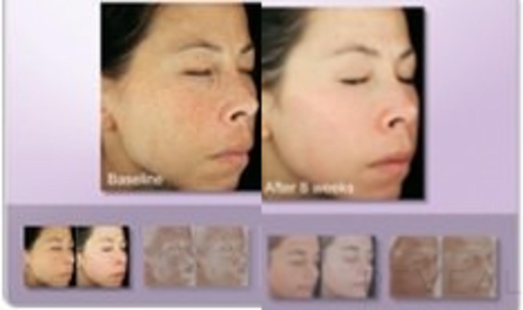 Before & After Peels & Resurfacing Case 27 View #1 View in San Jose, CA
