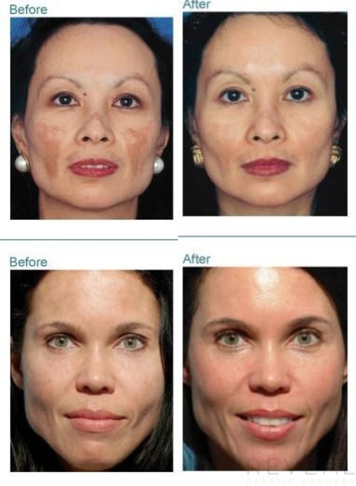 Before & After Skin Care Case 33 View #1 View in San Jose, CA