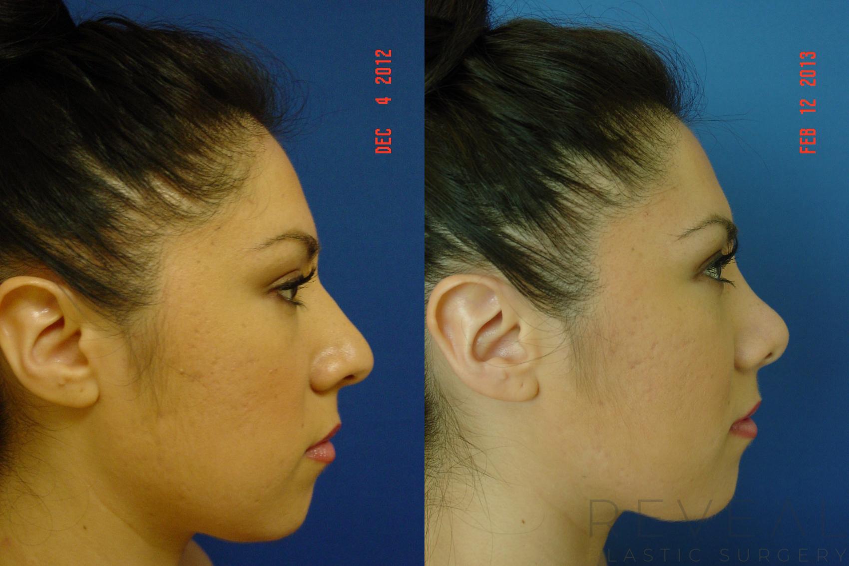 Before & After Rhinoplasty Case 100 View #1 View in San Jose, CA