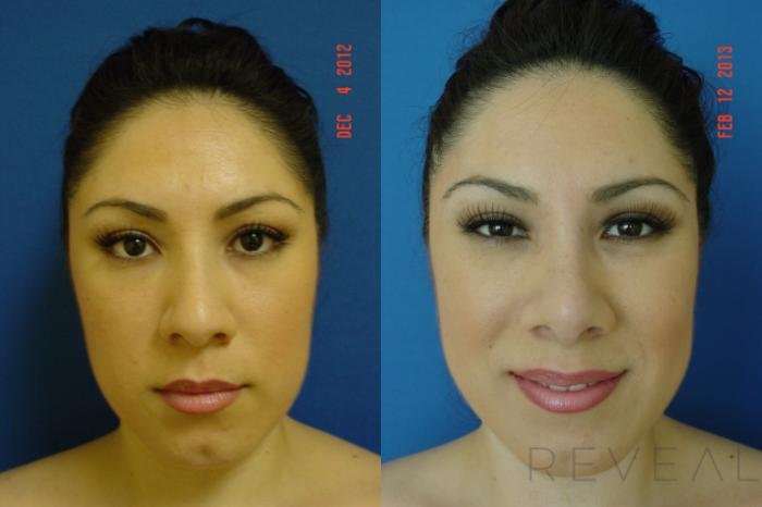 Before & After Rhinoplasty Case 100 View #2 View in San Jose, CA