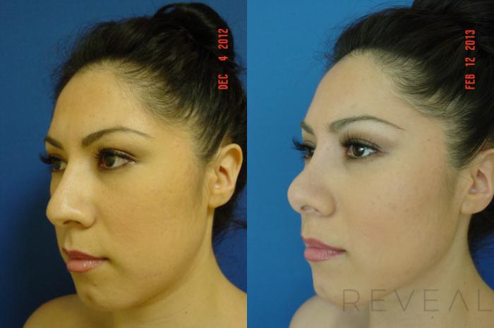 Before & After Rhinoplasty Case 100 View #3 View in San Jose, CA