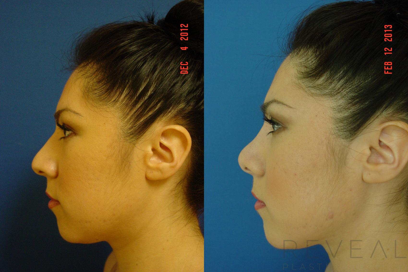 Before & After Rhinoplasty Case 100 View #4 View in San Jose, CA