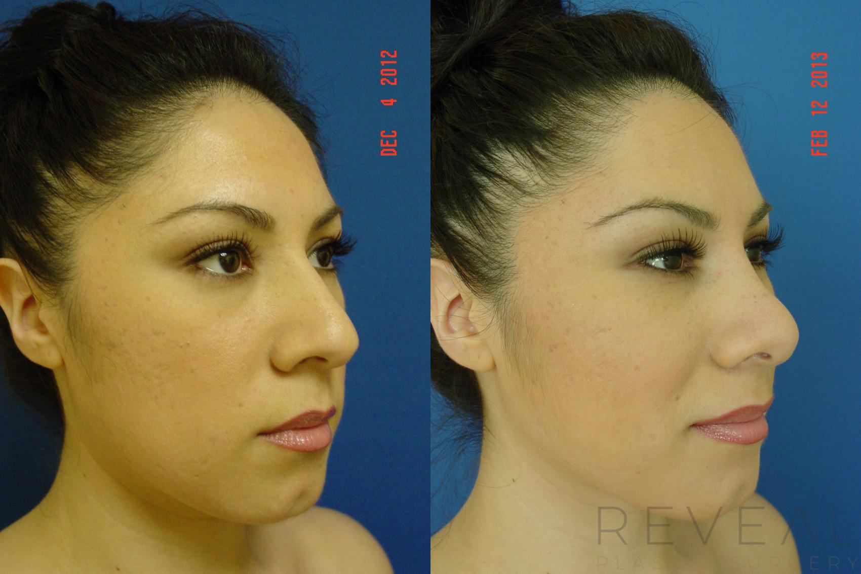 Before & After Rhinoplasty Case 100 View #5 View in San Jose, CA