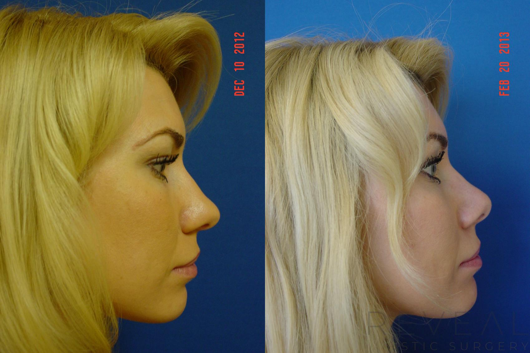 Before & After Rhinoplasty Case 101 View #1 View in San Jose, CA