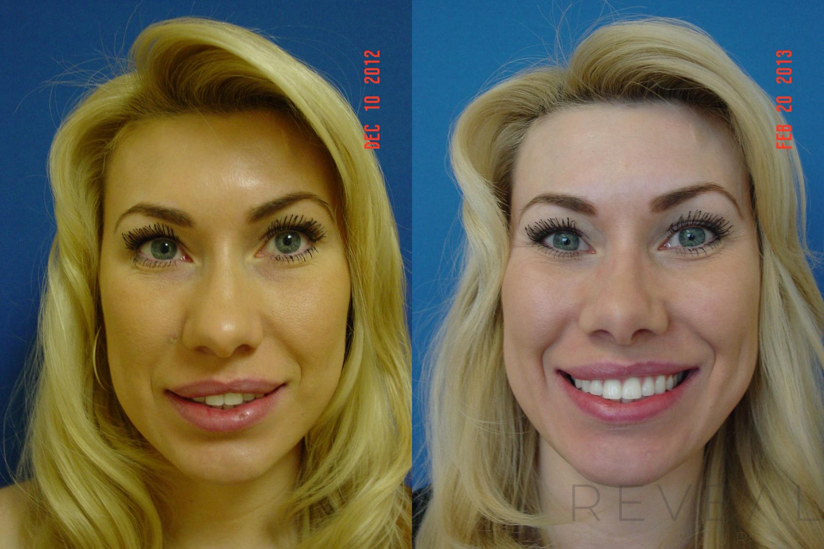Before & After Rhinoplasty Case 101 View #2 View in San Jose, CA