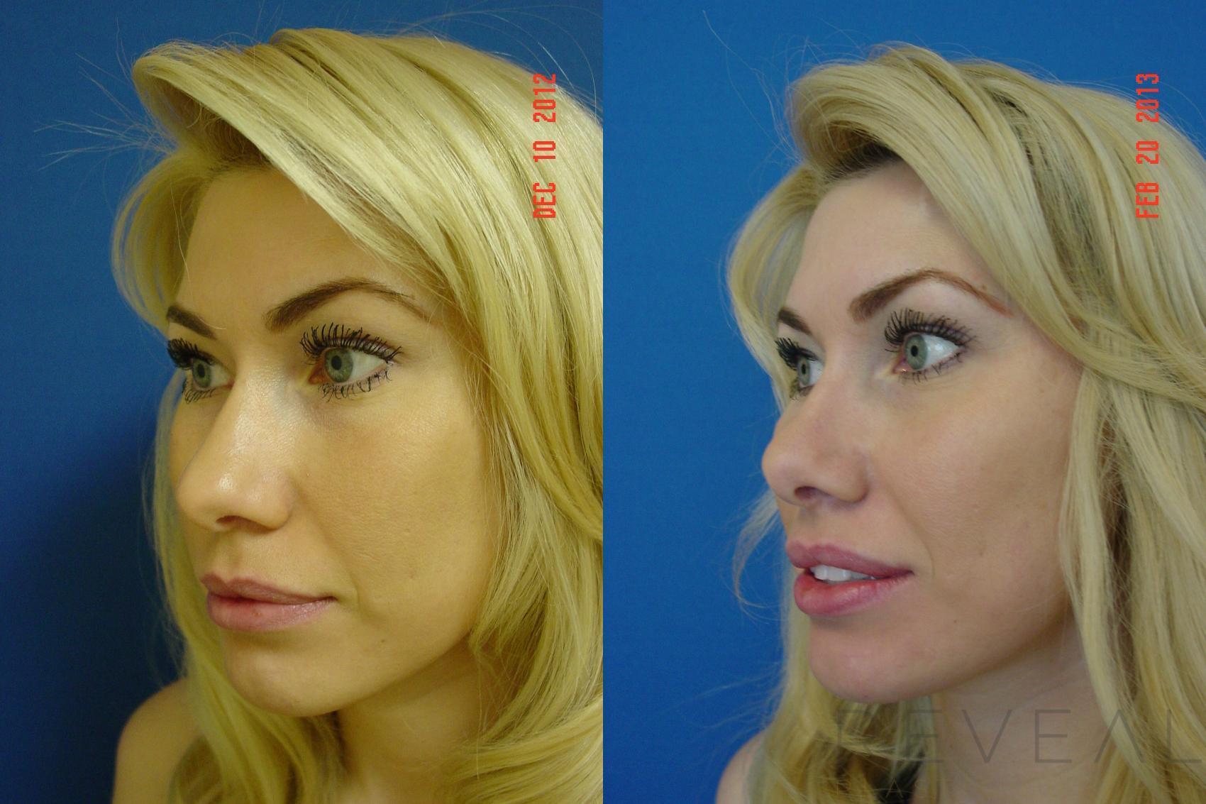 Before & After Rhinoplasty Case 101 View #3 View in San Jose, CA
