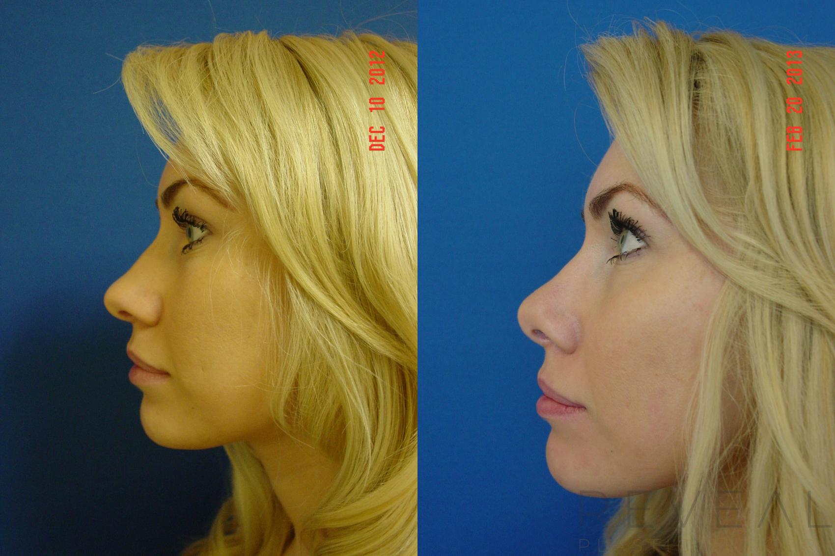 Before & After Rhinoplasty Case 101 View #4 View in San Jose, CA