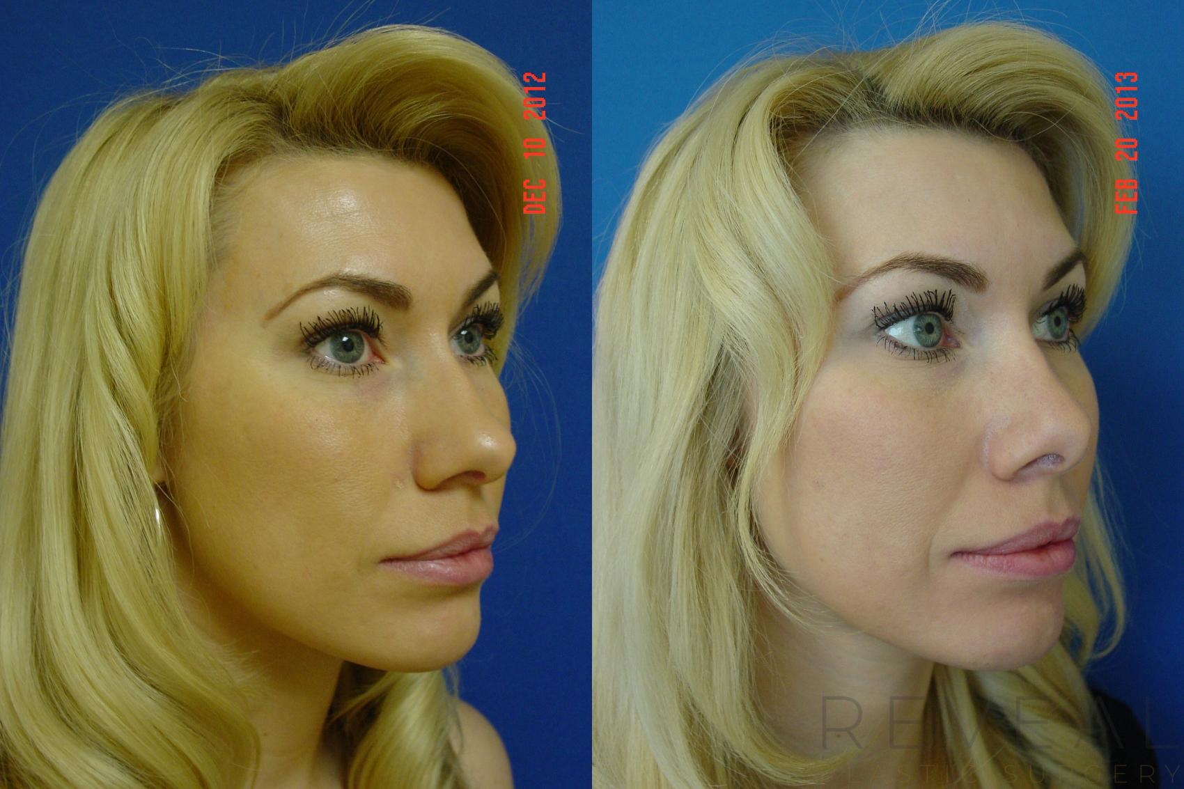 Before & After Rhinoplasty Case 101 View #5 View in San Jose, CA