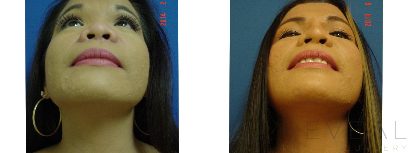 Before & After Rhinoplasty Case 157 View #1 View in San Jose, CA