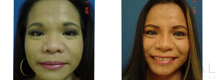 Before & After Rhinoplasty Case 157 View #2 View in San Jose, CA